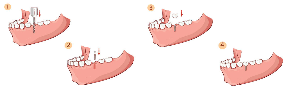 Houston Dental Implant Restoration
