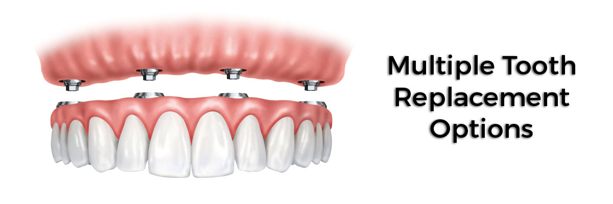 Houston Multiple Teeth Replacement Options