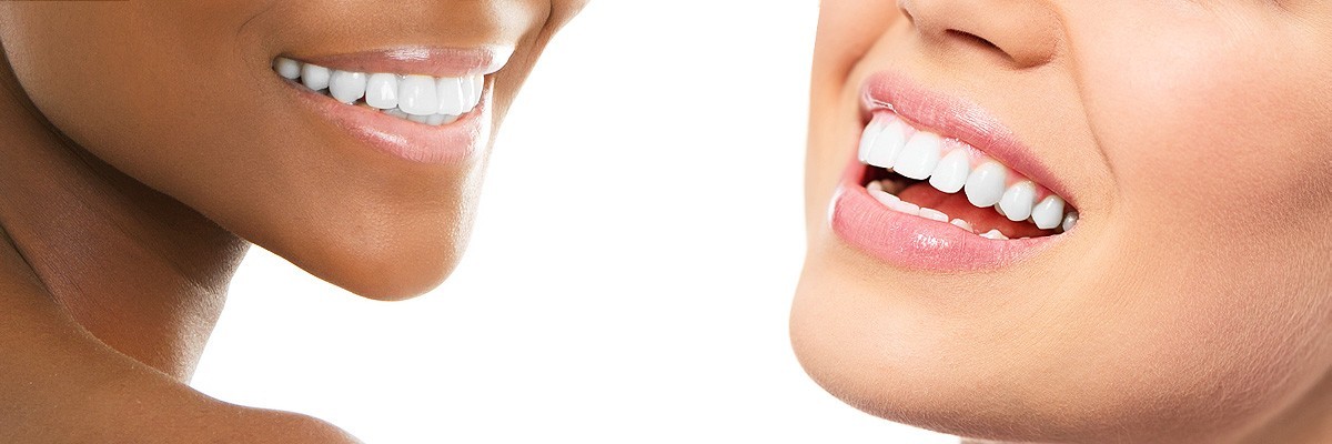 Houston Teeth Whitening