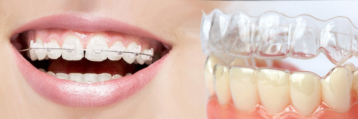 Houston Which is Better Invisalign or Braces
